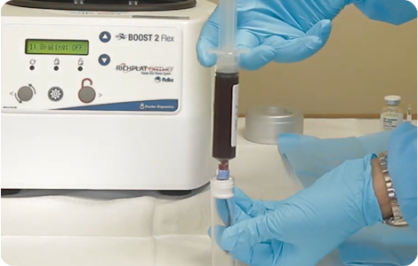 Photo of transferring whole blood into the PRP concentrating tube